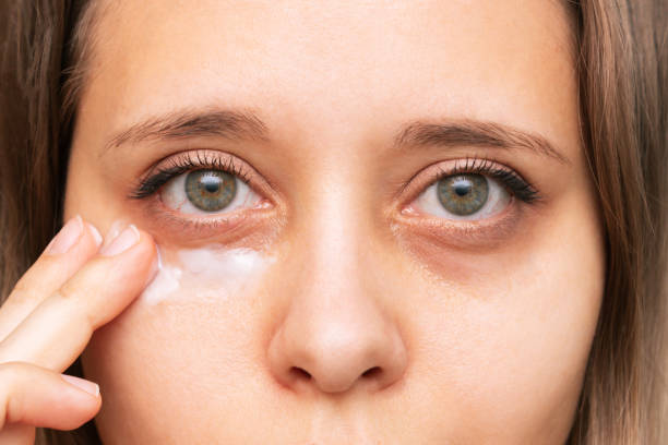 Makeup Tips for Hiding Bruises Effectively