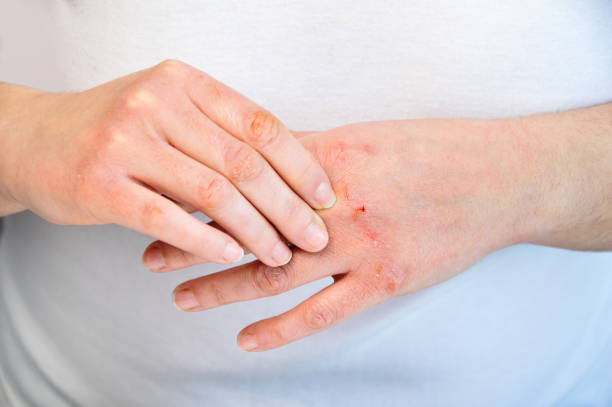 Close-up of hands with dry, cracked skin applying cream, demonstrating treatment for dehydrated skin.